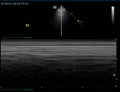 M-mode showing absence of lung sliding, often described as the “barcode sign”