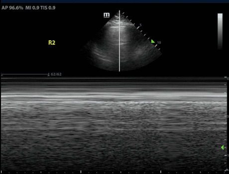 M-mode showing presence of lung sliding, often described as “waves on a sandy beach”