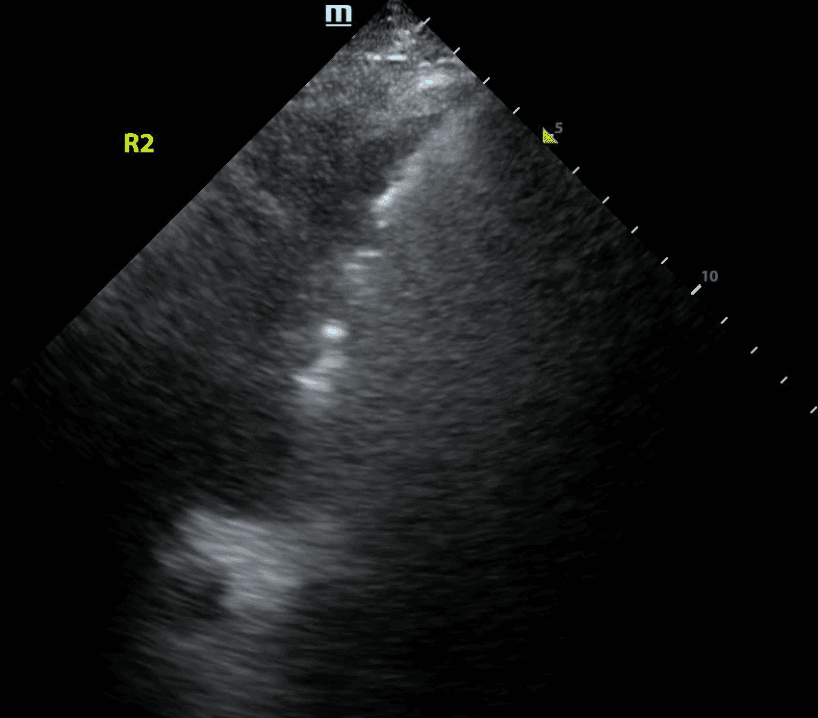 Large subpleural consolidation with shred sign seen in the anterior lung