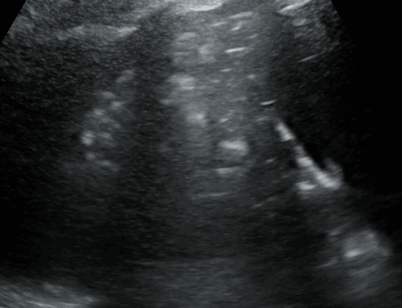 Depiction of air bronchograms in consolidated lung