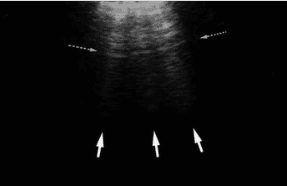 Normal Z line lung ultrasound pattern