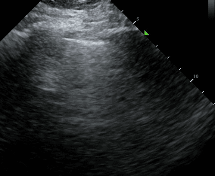 2-Dimensional representation of lung sliding