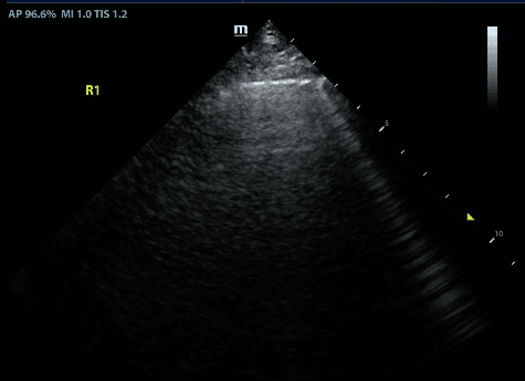 The presence of a B line at a certain point rules out a pneumothorax at that point