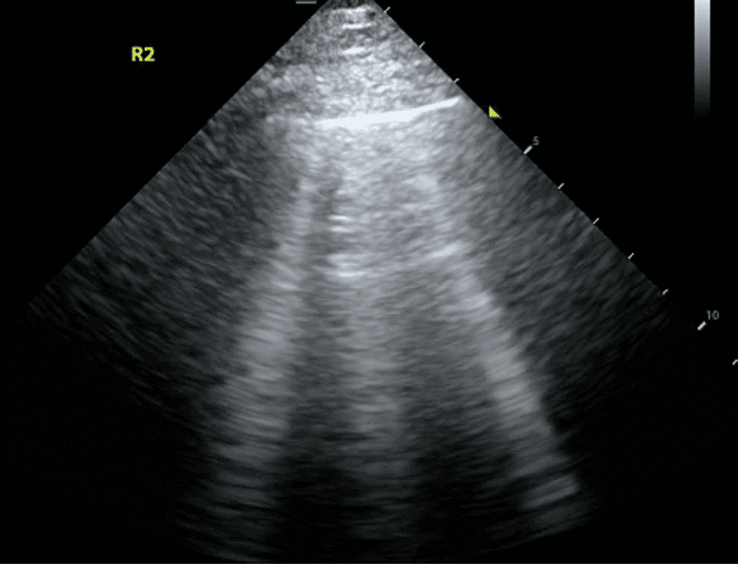 Lung ultrasound in the anterior chest depicting an abnormal B line pattern