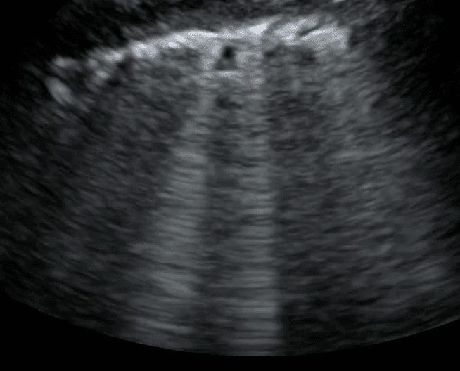 Presence of a B line with an irregular, thick pleural line