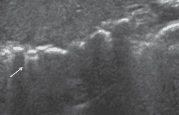 E line pattern on lung ultrasound