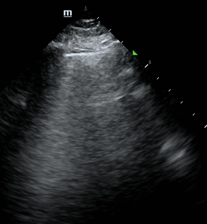 Presence of a B line with a smooth, thin pleural line